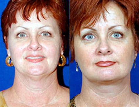 facial liposuction santa barbara